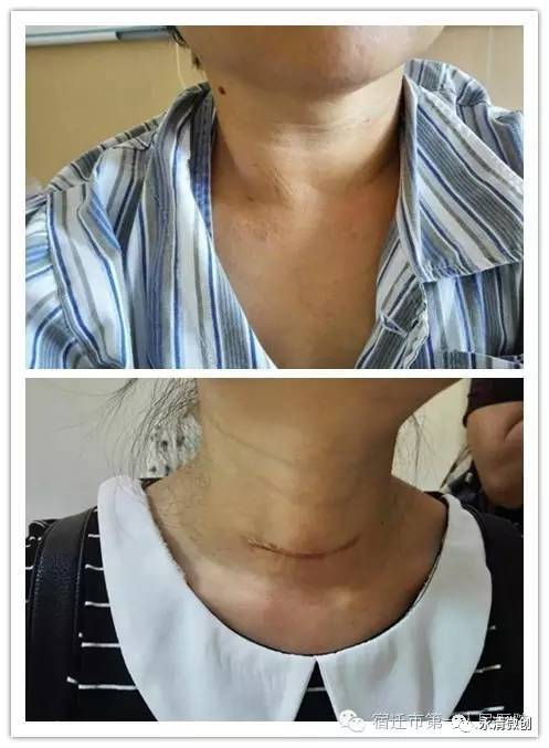 永清县人民医院外一科 引进甲状腺肿瘤无疤微波消融治疗