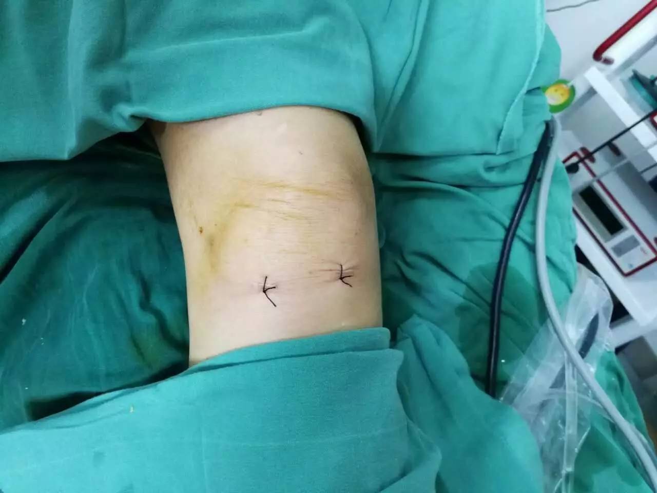【永医前沿】骨科自主完成关节镜下膝关节骨性关节炎关节清理＋半月板成形术！