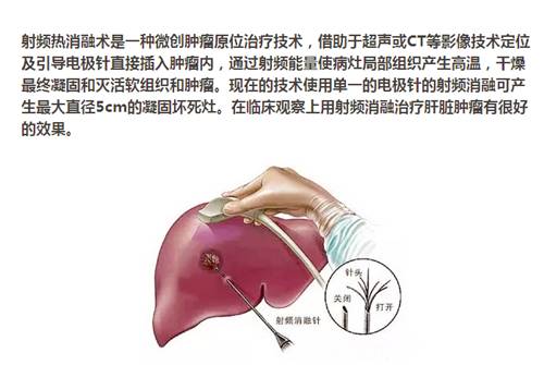 【永医前沿】外三科顺利完成“CT定位下肝肿瘤射频消融手术”！