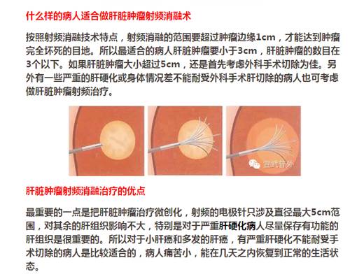 【永医前沿】外三科顺利完成“CT定位下肝肿瘤射频消融手术”！