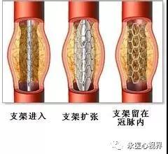 冠状动脉造影适应症