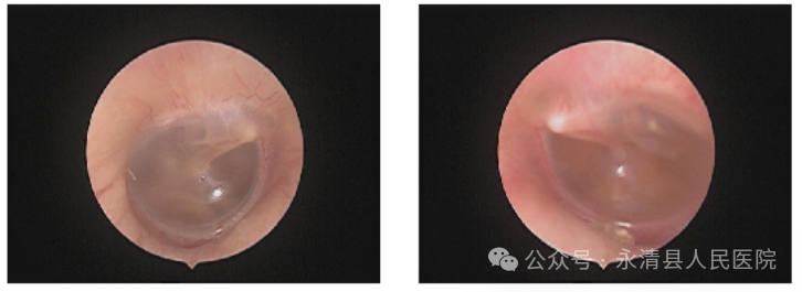 分泌性中耳炎——不流脓的中耳炎