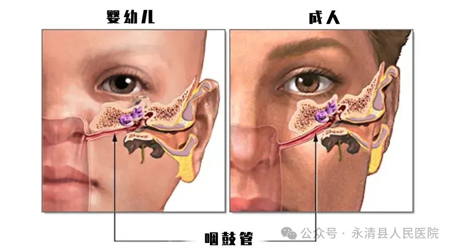 分泌性中耳炎——不流脓的中耳炎
